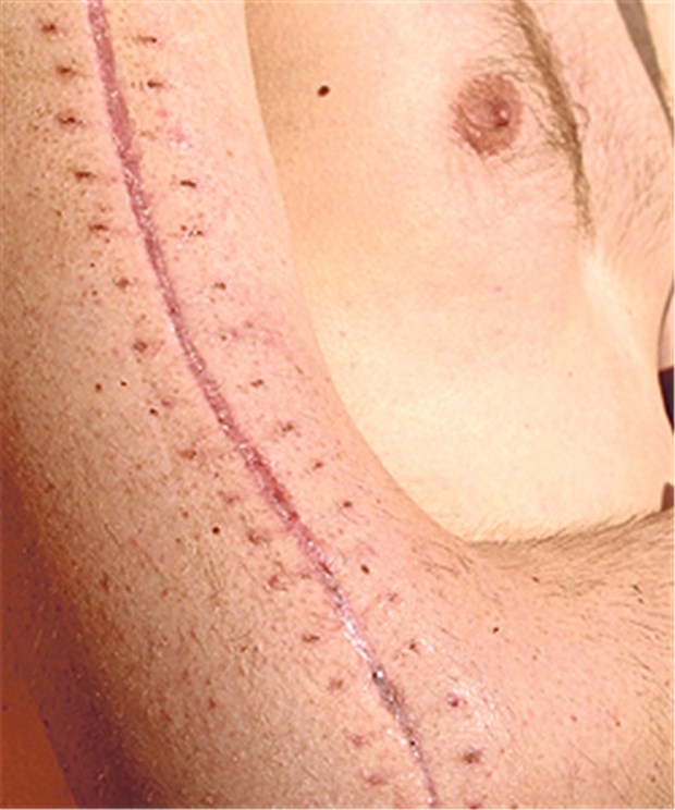 Kälte-Behandlung von innen bietet Vorteile Nicht immer läuft die Wundheilung nach Op perfekt. Bilden sich Keloide, können Betroffene von intraläsionaler Kryotherapie profitieren.