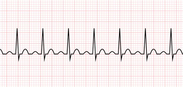 Nicht nur Hyperglykämien sind schädlich. Auch häufige Hypoglykämien können etwa zu Tachykardien und Tachyarrhythmien führen.
