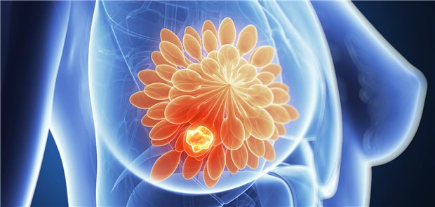 Nicht nur das Risiko für Brustkrebs ist nach überstandener Krebserkrankung in der Kindheit infolge der Krebstherapie häufig erhöht. Auch Darm und Herz gilt es, im Erwachsenenalter bei den Betroffenen verstärkt im Blick zu haben.