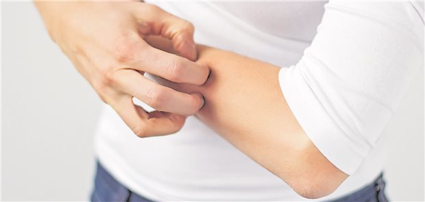 Nicht nur der Juckreiz beeinträchtigt die Lebensqualität von Patientinnen und Patienten mit atopischer Neurodermitits.