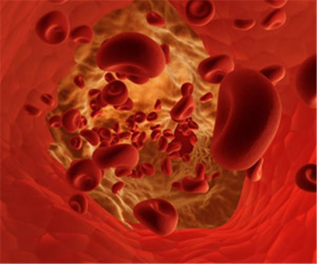 LDL sehr niedrig, Blutdruck normal - das stoppt Atherosklerose Niedriger LDL-Wert und normale Blutdruckwerte halten die Arterien frei.