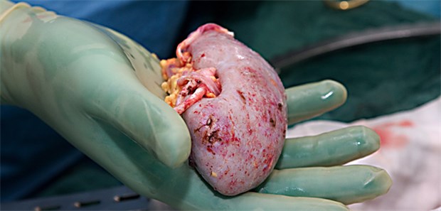Lebendspende in Heidelberg schlägt Wellen Niere ex vivo: Haben sich Heidelberger Transplanteure einen Kunstfehler mit Todesfolge geleistet?