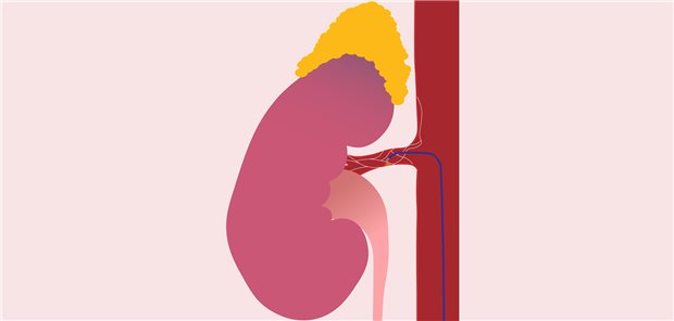 Nierendenervation als Methode mit blutdrucksenkender Wirkung – jetzt doch?