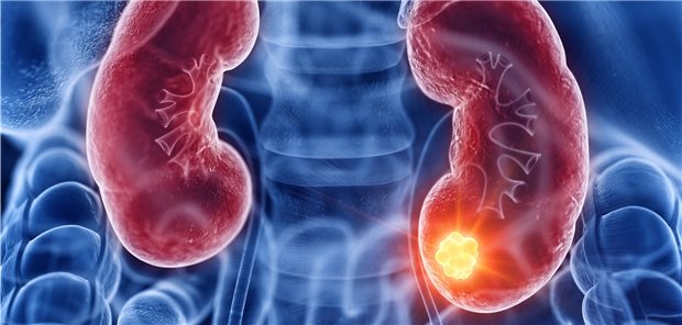 Nierenkrebs: Unter einer Behandlung mit Pembrolizumab überlebten 77,3 Prozent der Patienten zwei Jahre lang rückfallfrei, mit Placebo waren es 68,1 Prozent.