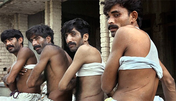 Organhandel wird zu globalem Problem Nierenspender gegen Bares in Pakistan: Organhandel ist laut UNODC ein globales Problem.