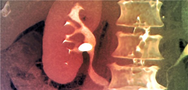 Nierenstein in einer kolorierten CT-Aufnahme. Je stärker der dadurch bedingte Schmerz, desto schneller wird häufig interveniert – zu Recht?