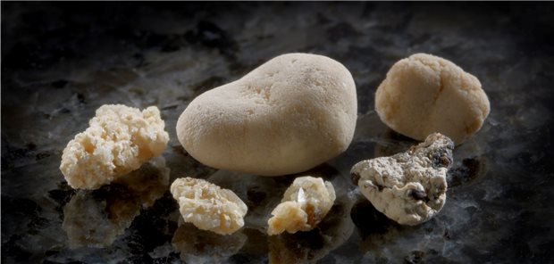 Nierensteine: Aus Sicht von US-Forschern ist die Diagnostik mit Sammelurin nicht mit reduzierten Raten von Steinrezidiven assoziiert.