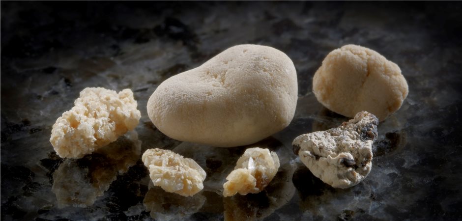 Diagnostik mit Sammelurin verhindert keine Steinrezidive