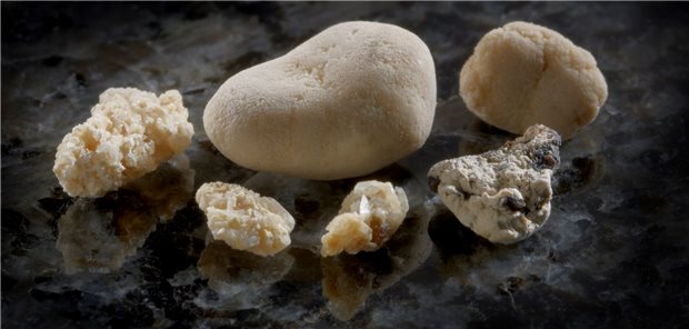 Nierensteine bei Urolithiasis