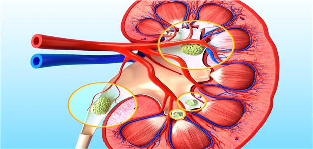 Nierensteine: Für Kalziumoxalat-Steinbildner könnte hartes Wasser von Vorteil sein.