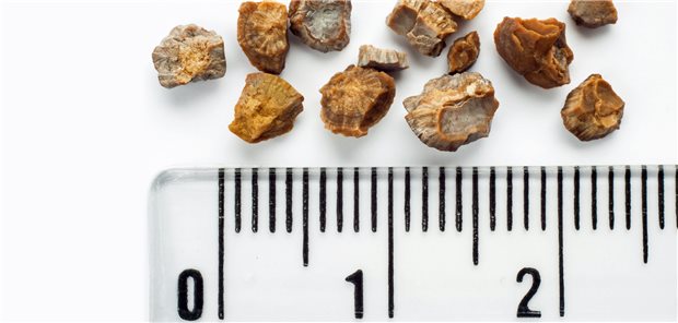 Nierensteine – manche sind symptomatisch, manche asymptomatisch.
