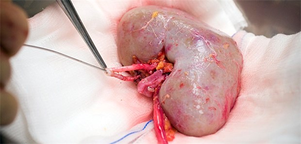 Nanopartikel verlängern Haltbarkeit von Spenderorganen Nierentransplantation: In den USA werden – anders als in Deutschland – oft Spenderorgane, vor allem Spenderherzen, verworfen, weil sie nicht schnell genug an Spender weitergereicht werden können.