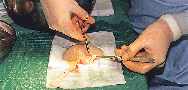 Werden mögliche Organ-Spender einfach übersehen? Nierentransplantation: Rund 8000 Dialysepatienten warten in Deutschland derzeit auf ein Organ.