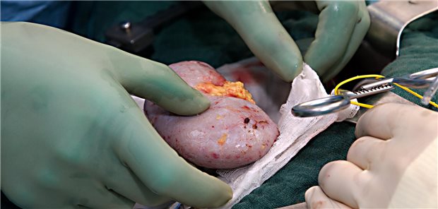 Nierentransplantation