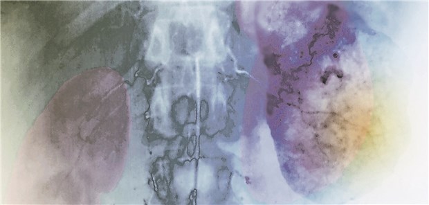 Nierenzellkarzinom: Die Hypothese von seiner großen Heterogenität wird diskutiert.