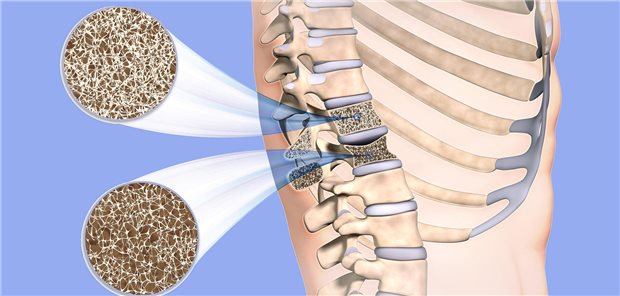 Nimmt die Knochendichte durch Osteoporose (oben: Längsschnitt durch gesunden Rückenwirbel, unten: durch einen osteoporotisch geschädigten), drohen Frakturen. Wirbelkörper sind neben Hüfte, Handgelenken, Oberarm und Becken besonders gefährdet.