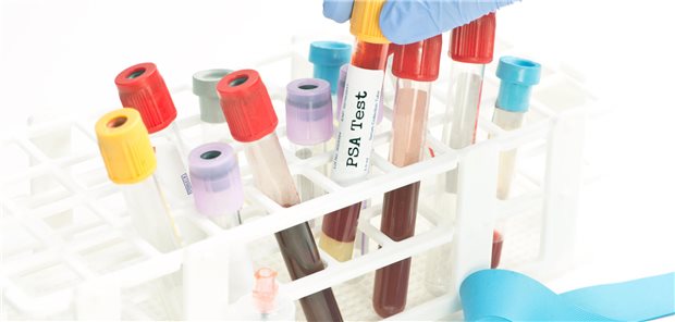 Noch wird Männern mit einem PSA < 1 ng/ml zu einem Screening-Intervall von vier Jahren geraten.