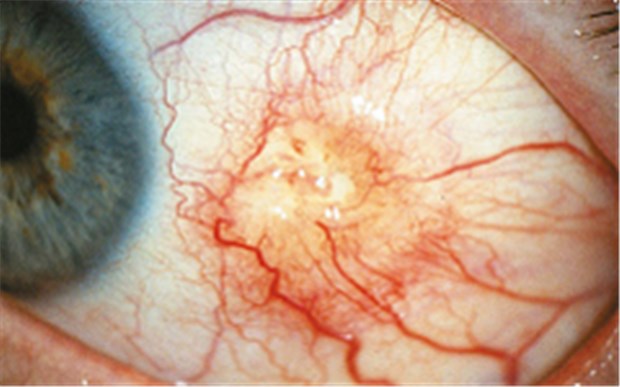 Jeder vierte Rheumatiker hat Probleme mit den Augen Noduläre Skleritis bei Rheumatoider Arthritis mit umschriebener ulzerativer Manifestation.