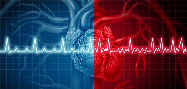 Normaler Herzrhythmus (links) und Vorhofflimmern (rechts) im EKG.
