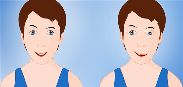 Normales Gesicht (links) und Gesicht mit typischen Zeichen von Myasthenia gravis (rechts): Ptosis des Augenlids und hängende rechte Gesichtshälfte.