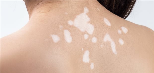 Ob bei Vitiligo-Läsionen die Behandlung mittels Laser oder IPL indiziert ist, hängt auch von individuellen patientenbezogenen Risikofaktoren ab.