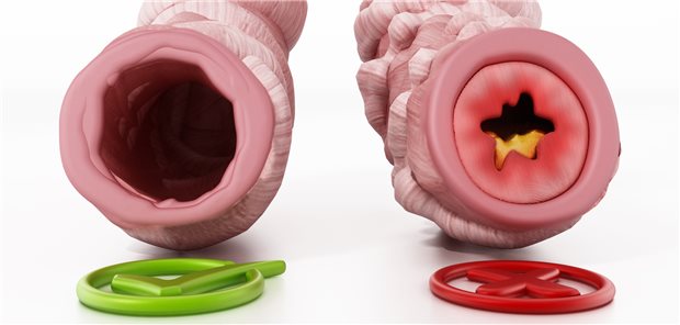 Obstructed and unobstructed bronchial tubes representing asthma. 3D illustration.