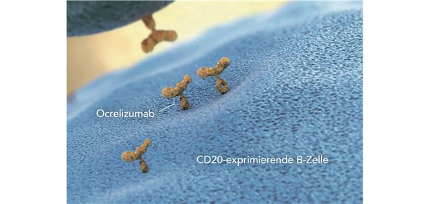 Ocrevus®– erste Therapie bei aktiver RMS und PPMS durch B-Zell-Depletion Ocrelizumab bindet zielgerichtet an das Oberflächenprotein CD20 auf CD20-exprimierenden B-Lymphozyten. Letztendlich wird infolgedessen die Entzündungsaktivität gebremst und so die Zahl der MS-Schübe reduziert.