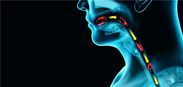 Ösophagus: Patienten mit einer lang bestehenden Eosinophilen Ösophagitis haben oft Dysphagie-Symptome und deutliche endoskopische Veränderungen im Ösophagus.