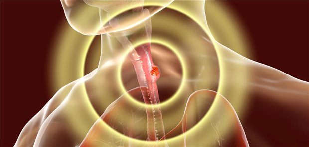 Ösophaguskarzinom in 3D-Darstellung