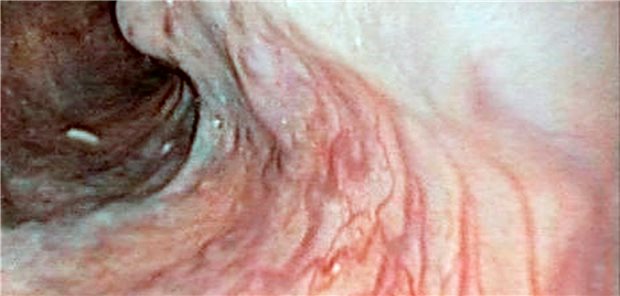 Ösophagusvarizen: Wissenschaftler haben untersucht, welche Therapieoption die besten sind.