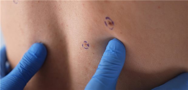 Ein Dermatologe mit blauen Handschuhen untersucht im Rahmen einer Hautkrebsvorsorgeuntersuchung die durch einen Kreis als auffällig markierten Muttermale auf dem Rücken eines Mannes.