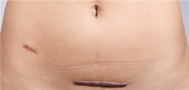 Op-Narben nach Hysterektomie: Der Eingriff ist bei Krebserkrankungen oft unumgängich.