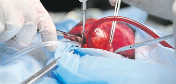 Jahrelanges Infektions-Mysterium aufgeklärt Op am offenen Herzen: Dabei wurden seit 2013 über hundert Patienten mit M. chimaera infiziert.