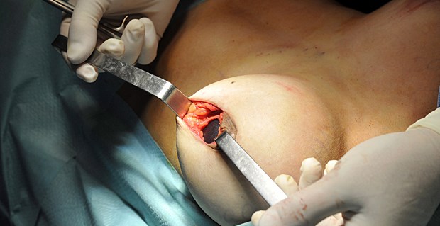 PIP-Brüste kommen Frauen teuer zu stehen Op zur Explantation eines Silikonimplantats aus der Brust.