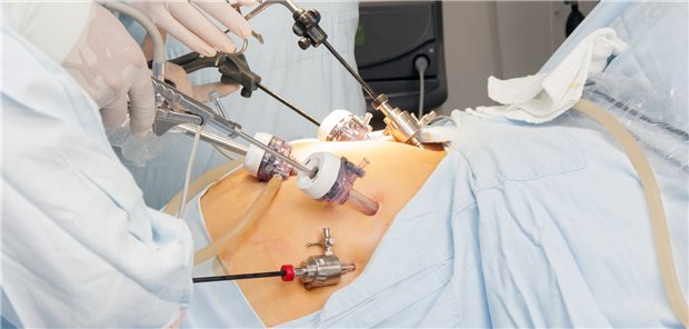 Operation für einen Magen-Bypass: Der Eingriff wird in der Regel minimalinvasiv vorgenommen.