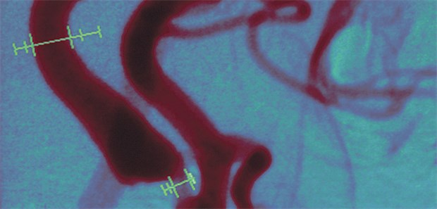Endarterektomie schlägt Stenting Operation oder Stenting? Darstellung einer filiformen Stenose der Arteria carotis in der MRT-Angiografie.