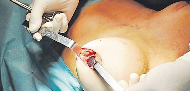 PIP-Skandal - ein Jahr danach Operation zur Explantation eines Silikonimplantats aus der Brust.