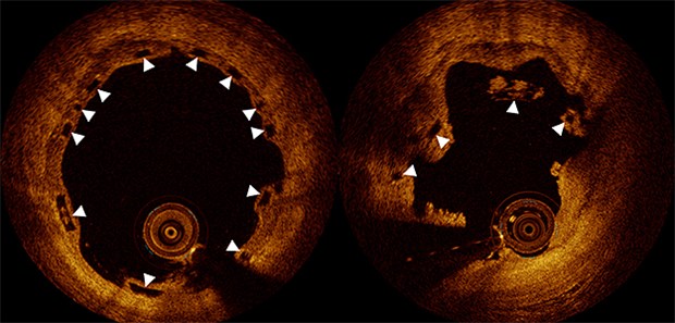 Warum Biostents das Herzinfarkt-Risiko erhöhen Optische Kohärenztomographie: Obwohl zehn Monate nach Implantation die Position des Bio-Stents korrekt ist (links), sind sechs Monate später die Stentstreben eingebrochen (rechts).