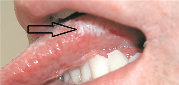Orale Haarleukoplakie: Asymptomatische, nicht abwischbare weißliche Verhornung am Zungenrand.