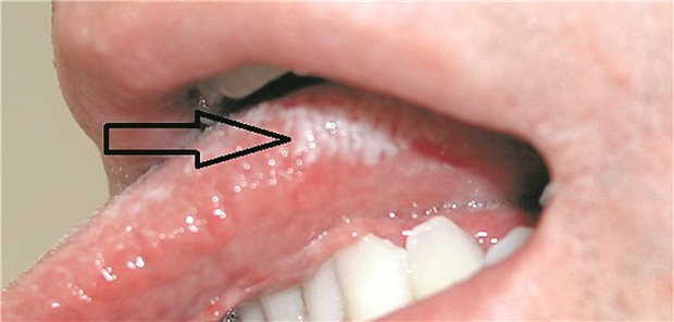 Orale Haarleukoplakie: eine eindeutige Indikatorerkrankung für HIV.