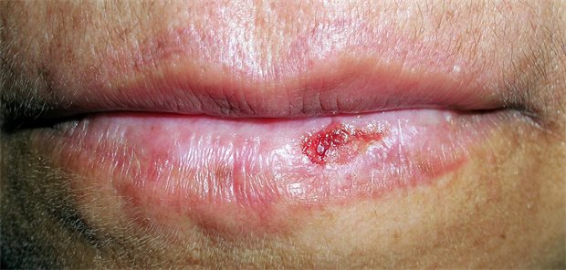 Eine verkrustete Blase auf der Lippe eines Mannes.