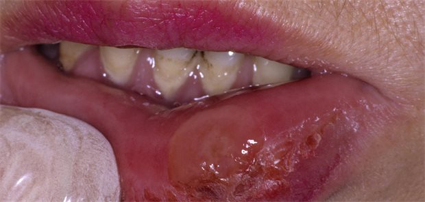 Was steckte hinter den schlecht heilenden Ulzera im Mund? Syphilis-Läsion im Mund einer infizierten Person.