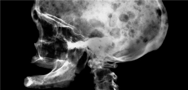 Osteolysen am Schädel eines Patienten mit multiplem Myelom.