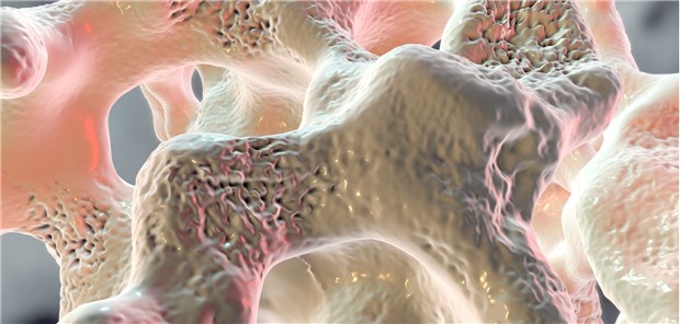 Osteoporose: Für Frauen und Männer gibt es gute Therapieoptionen.