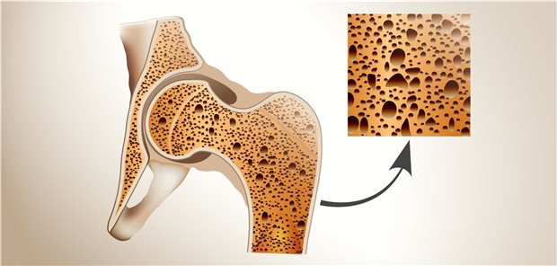 Osteoporose: In Deutschland wird die Prävalenz bei den über 50-jährigen Frauen mit 24 Prozent beziffert.