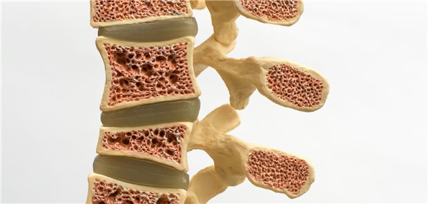 Osteoporose: Mit einer Psoriasisarthritis war eine um 22 Prozent höhere Wahrscheinlichkeit einer Osteoporose oder Osteopenie assoziiert.