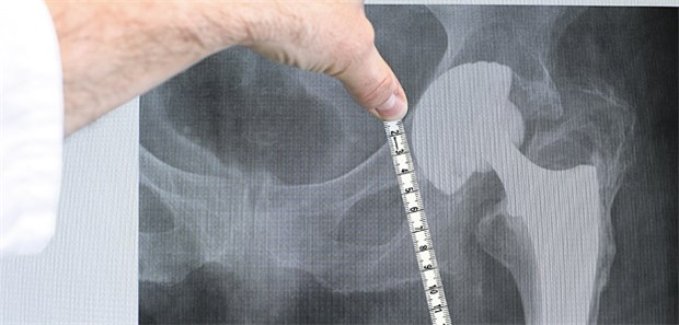 App sichert sektorübergreifenden Pfad Osteoporose-Patienten zählen zu potenziellen Empfängern von Totalendoprothesen.