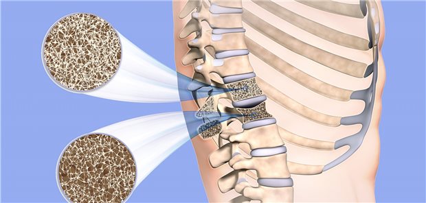 Osteoporose im Rückenwirbel: Wann bei der medikamentösen Therapie eine Umstellung notwendig ist, lässt sich anhand des individuellen Frakturrisikos klären.