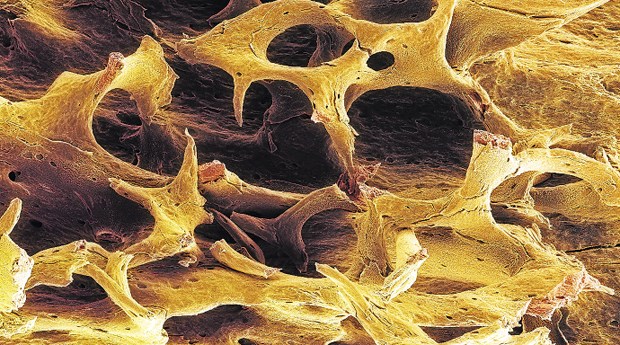 Osteoporotisch veränderter Knochen im Elektronen-Mikrograph.