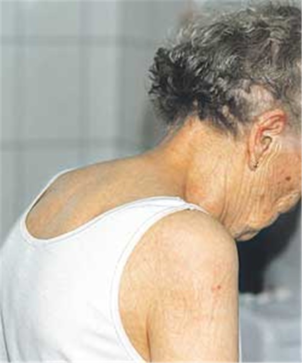Bisphosphonat-Therapie: Da muss der Vitamin-D-Spiegel stimmen Osteoporotischen Wirbelfrakturen lässt sich vorbeugen.